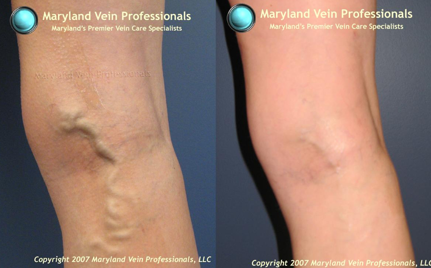 Why Varicose Veins Are Dangerous As Well As Painful ...